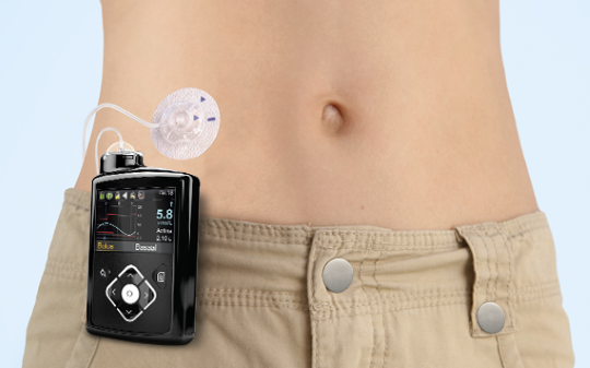 Insulin pump treatment — Our care — Diabeter : type one diabetes care